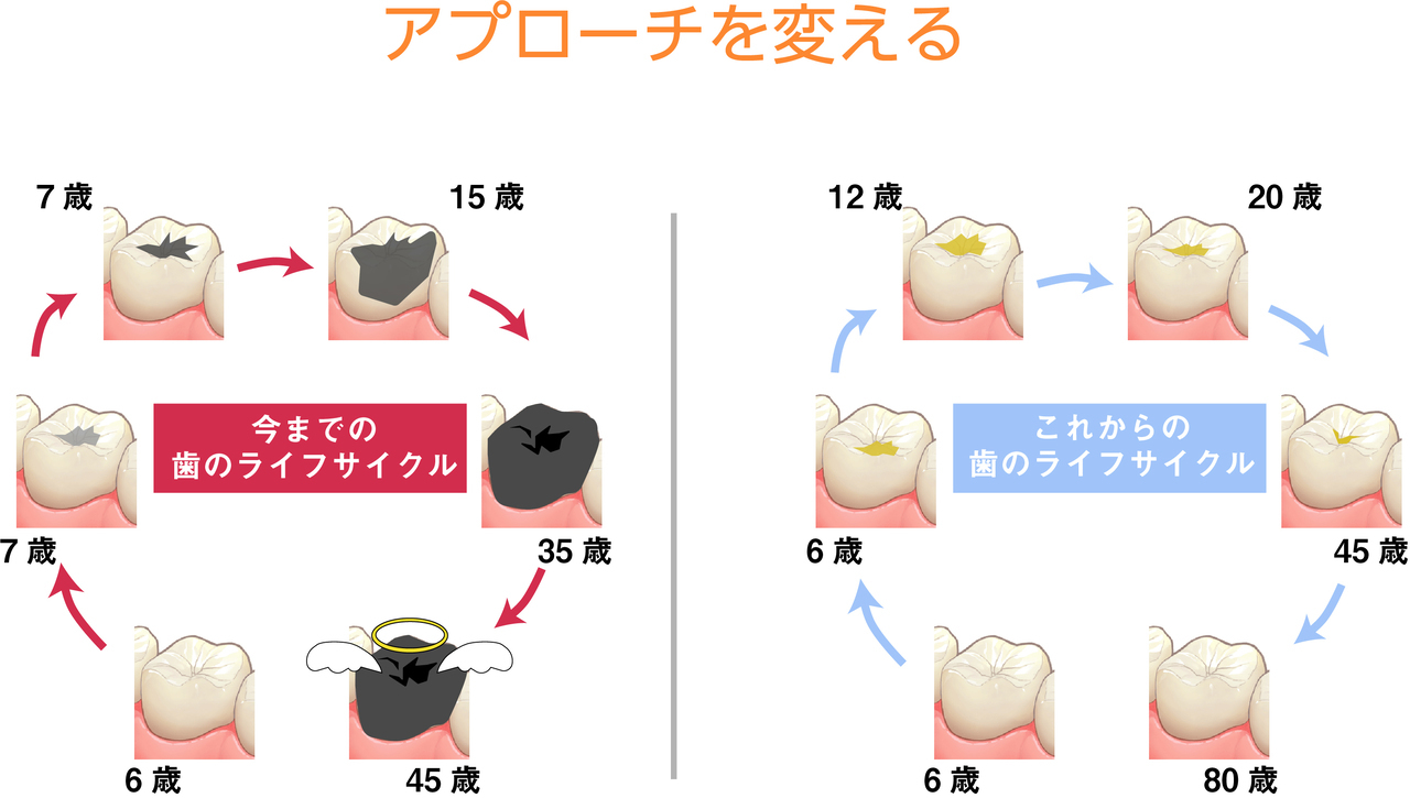 武蔵境の虫歯（歯に穴）ができるまで